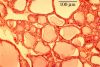 Filename=thyroid20X.jpg
Filesize=168KiB
Dimensions=1024x694
Date added=Mar 07, 2009 thyroid20X.jpg
