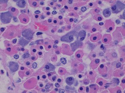 Pituitary gland, pars distalis - histology slide
This is a histology slide of the pars distalis of the pituitary gland.

Histology slide courtesy of Mikael Häggström, MD. and Wikimedia Commons. No changes were made from the download. 

This file is made available under the Creative Commons CC0 1.0 Universal Public Domain Dedication (https://creativecommons.org/publicdomain/zero/1.0/deed.en).

