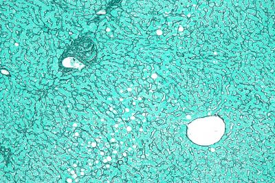 Liver - histology slide
Micrograph of the liver showing a portal tract and a nearby hepatic venule. Reticulin stain. The normal "hepatocyte plate" -- the strands of hepatocytes that characterise the morphology of the liver and are separated by the liver sinusoids -- is one or two cells thick, as shown in the image. (Description text from the Wikimedia Commons file page.)  

Image by [url=https://commons.wikimedia.org/wiki/User:Nephron]Nephron[/url], via Wikimedia Commons.

Original file source: [url=https://commons.wikimedia.org/wiki/File:Liver_reticulin.jpg]https://commons.wikimedia.org/wiki/File:Liver_reticulin.jpg [/url]

Title: "Liver_reticulin.jpg"

No changes were made to the original image downloaded (note: this version was downloaded at reduced resolution from Wikimedia Commons).

This file is licensed under the Creative Commons Attribution-Share Alike 3.0 Unported License [url=https://creativecommons.org/licenses/by-sa/3.0/deed.en]https://creativecommons.org/licenses/by-sa/3.0/deed.en[/url].

Copyright © 2009 Michael Bonert, MD, FRCPC ([url=https://commons.wikimedia.org/wiki/User:Nephron]https://commons.wikimedia.org/wiki/User:Nephron[/url] / [url=https://experts.mcmaster.ca/display/bonertm]https://experts.mcmaster.ca/display/bonertm[/url])

You are free to share and adapt this image as per the CC BY-SA 3.0 ([url=https://creativecommons.org/licenses/by-sa/3.0/legalcode]https://creativecommons.org/licenses/by-sa/3.0/legalcode[/url])


