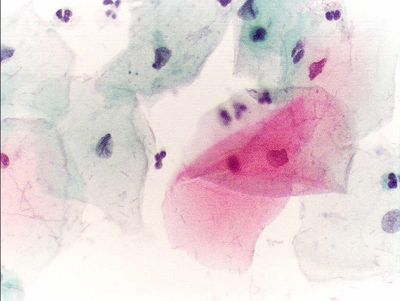 Papanicolau stain - cytology
Pap test, Papanicolau stain, 400x. Normal squamous epithelial cells in a premenopausal women. (Description text from the Wikimedia Commons file page.)

Source: Slide files from Hospital of Mionfalcone (Italy)
Author:  [url=https://commons.wikimedia.org/wiki/User:Alex_brollo]Alex_brollo[/url], via Wikimedia Commons 

Original file source: [url=https://commons.wikimedia.org/wiki/File:Pap_test_normal.jpg] https://commons.wikimedia.org/wiki/File:Pap_test_normal.jpg[/url]

Title: "Pap test normal.jpg"

No changes were made to the original image downloaded.  

Permission is granted to copy, distribute and/or modify this document under the terms of the GNU Free Documentation License, Version 1.2 or any later version published by the Free Software Foundation; with no Invariant Sections, no Front-Cover Texts, and no Back-Cover Texts. A copy of the license is included in the section entitled GNU Free Documentation License. [url=https://commons.wikimedia.org/wiki/Commons:GNU_Free_Documentation_License,_version_1.2]https://commons.wikimedia.org/wiki/Commons:GNU_Free_Documentation_License,_version_1.2[/url]

This file is licensed under the Creative Commons Attribution-Share Alike 3.0 Unported license. [url=https://creativecommons.org/licenses/by-sa/3.0/deed.en/]https://creativecommons.org/licenses/by-sa/3.0/deed.en/[/url]
