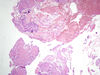 endometriumproliferative1.jpg