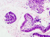 endometriumproliferative8.jpg